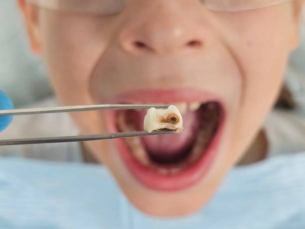 Best Emergency Dental Care for Broken or Chipped Teeth in Poplar Plains, CT